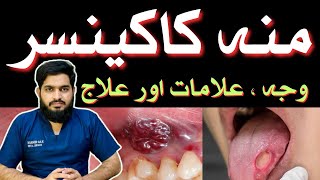 ORAL CANCER  Symptoms  Causes  Treatment  منہ کا کینسر  Urdu  Hindidrmuneermalik [upl. by Rudie]