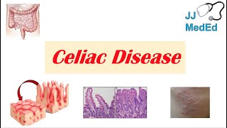 Celiac Disease amp Gluten Sensitivity Risk Factors Pathogenesis Symptoms Diagnosis Treatment [upl. by Nnylaj]