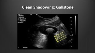 Ultrasound Artifacts  BAVLS [upl. by Aloke99]