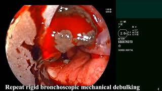 Tracheal Melanoma  Central Airway Obstruction Rigid bronchoscopic debulking [upl. by Yolande]