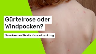 Gürtelrose oder Windpocken So erkennen Sie die Viruserkrankung [upl. by Notlem992]