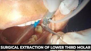 SURGICAL EXTRACTION OF LOWER THIRD MOLAR  LOWER THIRD MOLAR EXTRACTION  3rd MOLAR EXTRACTION [upl. by Yaya]