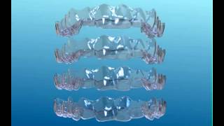 Orthodontic Clear aligners how aligners work invisalign [upl. by Meehsar]