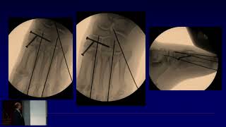 Lisfranc Ligament [upl. by Hanas]