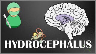 Hydrocephalus  Causes Types Signs and Symptoms Pathophysiology Diagnosis and Treatment [upl. by Eibor]