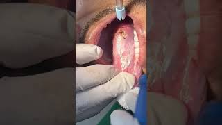 LEUKOPLAKIA REMOVAL [upl. by Ereveniug234]