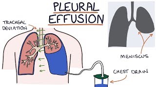 Understanding Pleural Effusions [upl. by Haeluj]