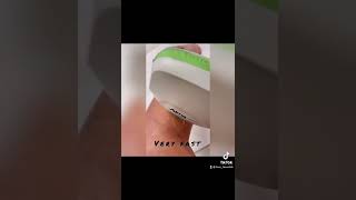 Amazing result Vein removal treatment with DyeVL laser technology [upl. by Malcah122]