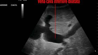 Vena cava inferiore dilatata [upl. by Udall]