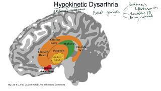 Hypokinetic Dysarthria  examples and tutorial [upl. by Eibbil896]