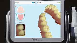 iTero® Scanner Tutorial Using the MultiBite Function [upl. by Auston790]