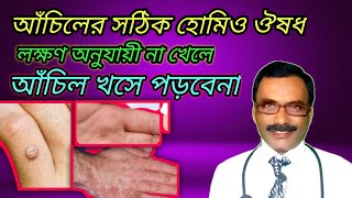 আঁচিলের সঠিক হোমিওপ্যাথিক ঔষধ  best homeopathic medicine for warts  Dr SP Goswami [upl. by Nodnahs]