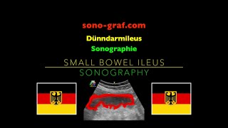 Sonographie  Dünndarmileus [upl. by Kemppe]