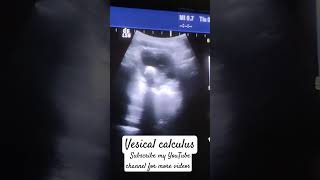 Vesical calculus on ultrasoundUrinary bladder pathology pelvic ultrasound [upl. by Varien]