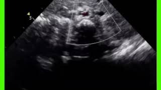 Dextrocardia Situs Inversus Echocardiography [upl. by Johann]