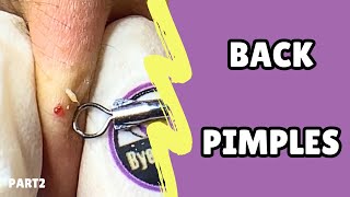 Extraction of back pimplesRelax with bye pimple💜pimple blackheads acne asmr [upl. by Enyleve]