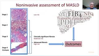 MAFLD MASLD NASH [upl. by Ertnod]