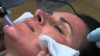 Dr Mark B Taylor Review of Dermapen Micro Needling  Gateway Aesthetics [upl. by Droffilc504]