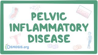 Pelvic inflammatory disease  causes symptoms diagnosis treatment pathology [upl. by Teirtza]