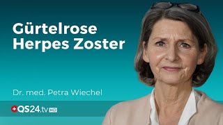 Gürtelrose Herpes Zoster was man wissen sollte Dr med Petra Wiechel Visite QS24 [upl. by Yunick]