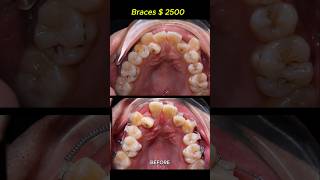 Cost  2500 for this case Braces crooked teeth braces orthodontist dentist [upl. by Rahal118]