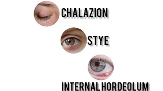 Chalazion vs External Hordeolum Stye vs Internal Hordeolum  Explained 👁️ [upl. by Casar]