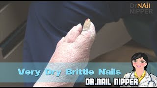 Very Dry Brittle Nails [upl. by Ahsahtan405]