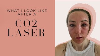 My CO2 Laser Experience PostTreatment Transformation and Recovery Tips by an Expert Dermatologist [upl. by Akkinahs464]