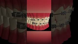 Dental Braces dentist medicalanimation [upl. by Enelrac]