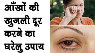 Eye Itching Home Remedy  Eye infection treatment  Aankho ki khujli ka ilaj in hindi  Ayurveda 2M [upl. by Scandura619]