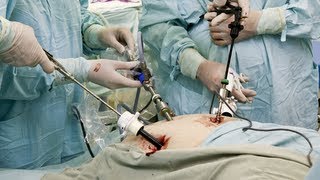 Laparoscopic Cholecystectomy [upl. by Yrrab]