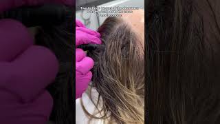 Thinnig Hair Receding Hairline Stem Cell Microneedling  Dr Medispa [upl. by Ytnom559]