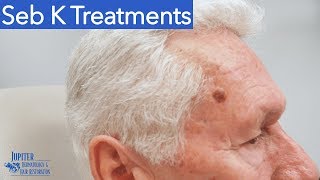 Seborrheic Keratosis Treatment amp Removal Liquid Nitrogen amp Curetagge [upl. by Ressan487]