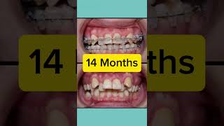 Orthodontics Case 14 Month Restoration [upl. by Naresh]