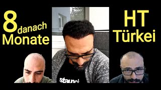 Haartransplantation Türkei 8 Monate Vorher Nachher Gencay😲 [upl. by Denni210]