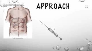 The Therapeutic Paracentesis tricks of the trade [upl. by Ahso]