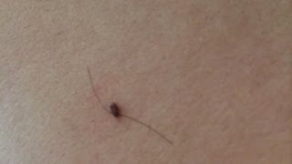 How To Get Rid of Skin Tags Naturally [upl. by Arytal477]