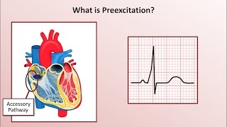 Advanced EKGs  WolffParkinsonWhite WPW Syndrome [upl. by Adnor]