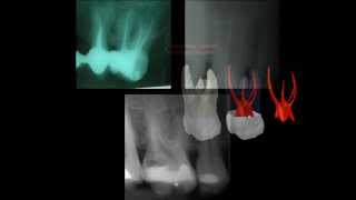 Primer molar superior [upl. by Aloel]