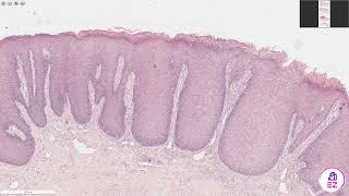 Chronic Hyperplastic Candidiasis [upl. by Giles965]