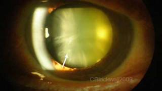 Understanding Cataract [upl. by Elokin]