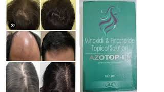 AZOTOP FN Topical Solution Minoxidil amp Finasteride Topical Solution [upl. by Millda947]