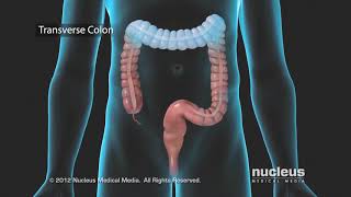 Colon Problems Diverticular Disease [upl. by Ahseken]