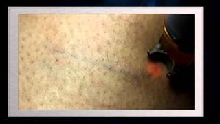 Tratamiento laser de varices de las piernas Nd YAG 1064 nm laser system [upl. by Ahsirak]