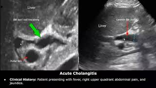 Bile Duct Ultrasound Reporting  CBD amp Hepatic Duct Pathologies amp Diseases  How To Write USG Report [upl. by Otsenre]