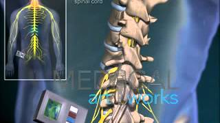 3D Medical Animation  Spinal stimulator surgery [upl. by Grania]