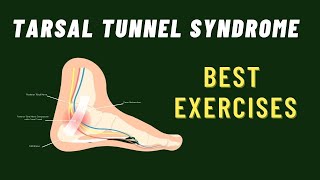 Tarsal Tunnel Syndrome 6 Best Exercises [upl. by Aicercal234]