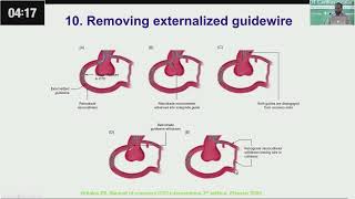 Retrograde CTO PCI Tips amp Tricks Wire Externalization by Dr Aftab khan [upl. by Naesad]