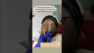 Mesoterapia Capilar Mesoterapia con Dutasteride para alopecia mesoterapia hair cabello salud [upl. by Tahpos387]