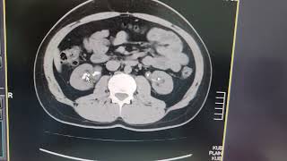 Bilateral renal calculi  Left ureteric calculus  CT KUB [upl. by Jesus]